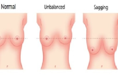 Breast Reduction Surgery in Mumbai